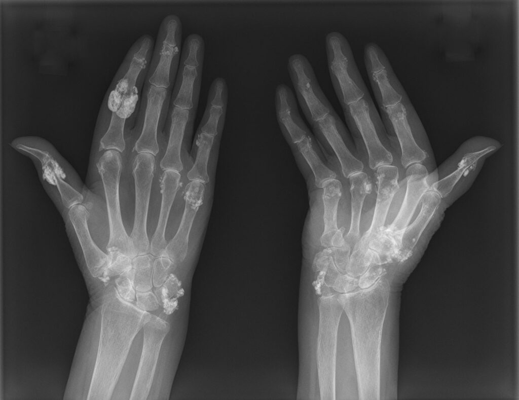 Scleroderma-X-Ray-Hands