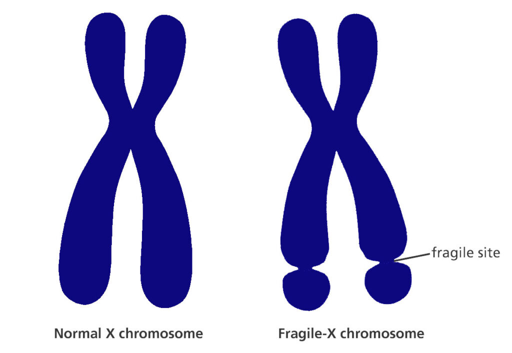 fragile-x-syndrome